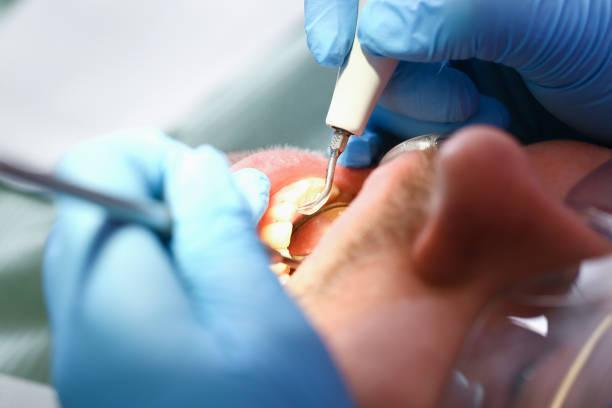 Best Emergency Root Canal Treatment in North Muskegon, MI